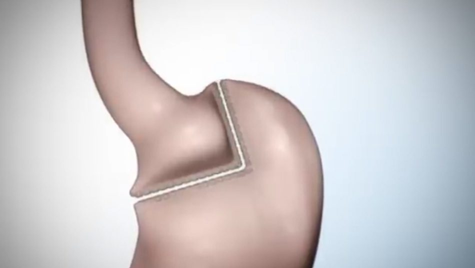 Video: Laparoscopic Gastric Bypass Covidien