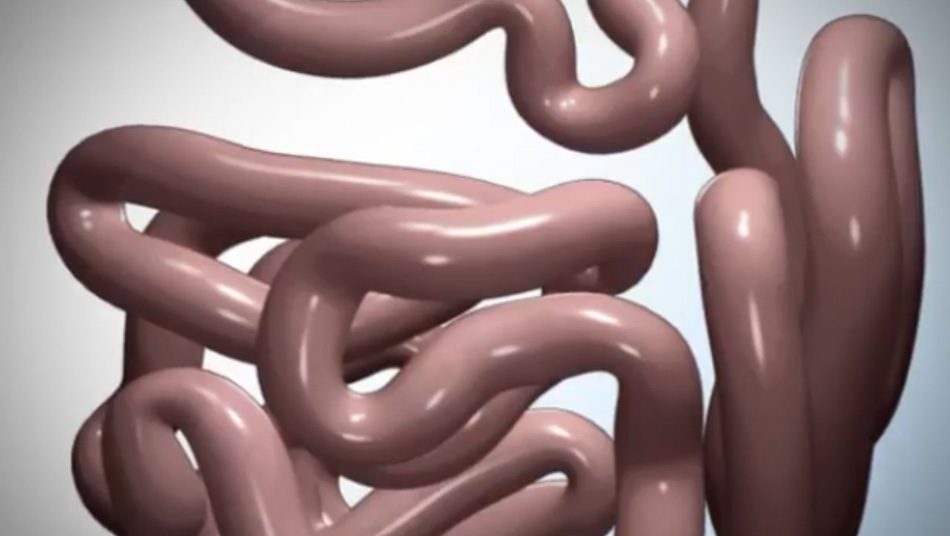 Video: Laparoscopic Sleeve Gastrectomy Covidien